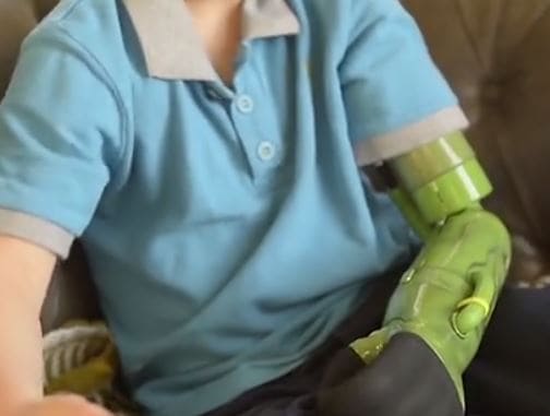 Un brazo con tecnología robótica le deja abrazar por primera vez a su hermano